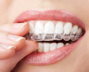 invisalign showing the benefits