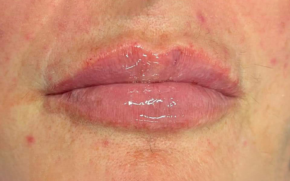 lip filler after 1