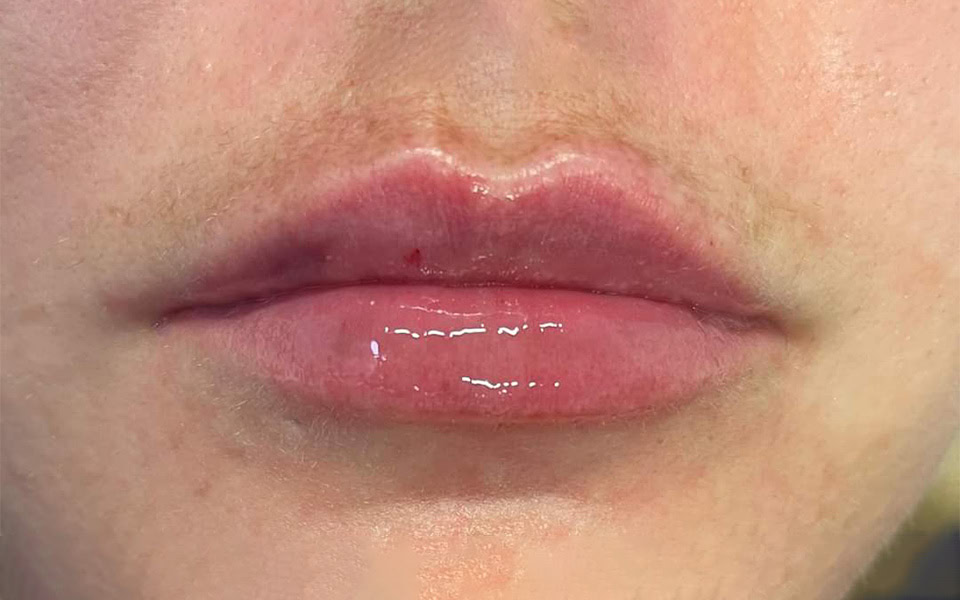 lip filler after 2