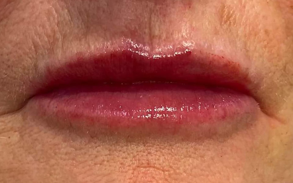 lip filler after 3