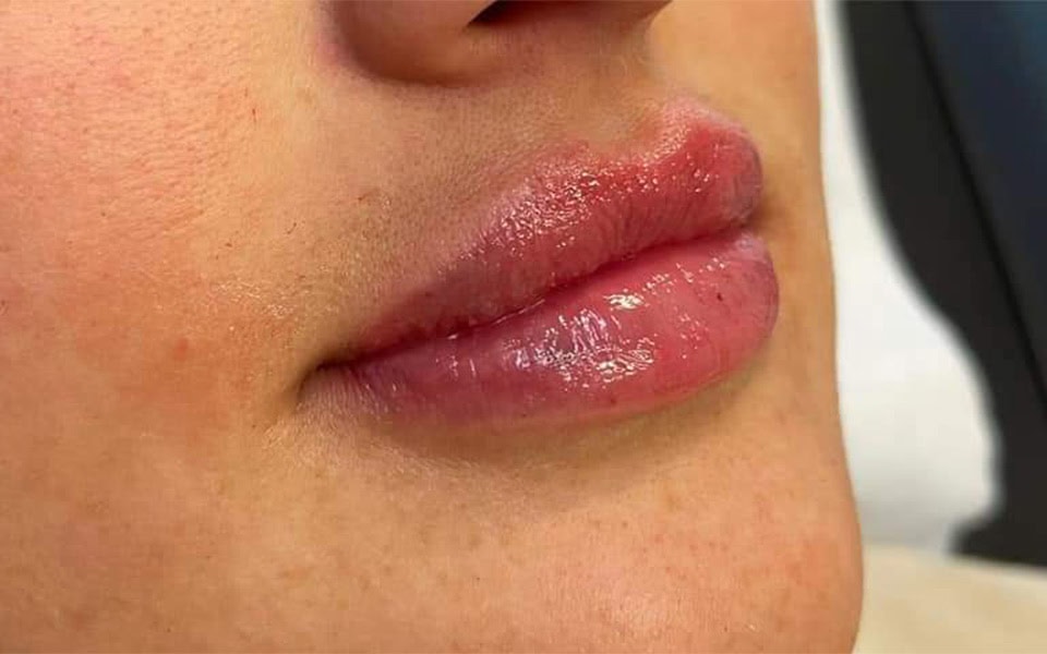 lip filler after 4
