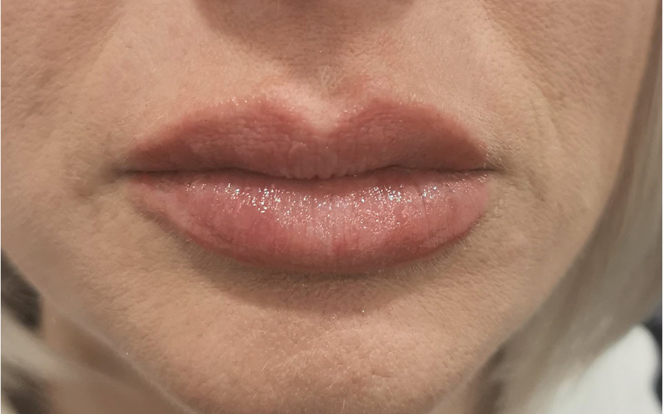 lip filler after 5