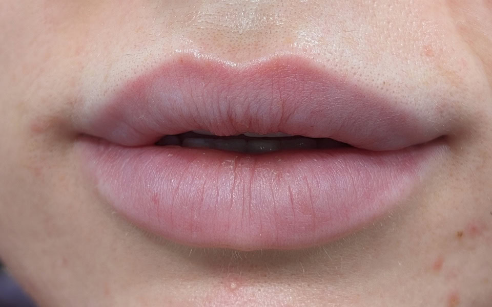 lip filler after 6