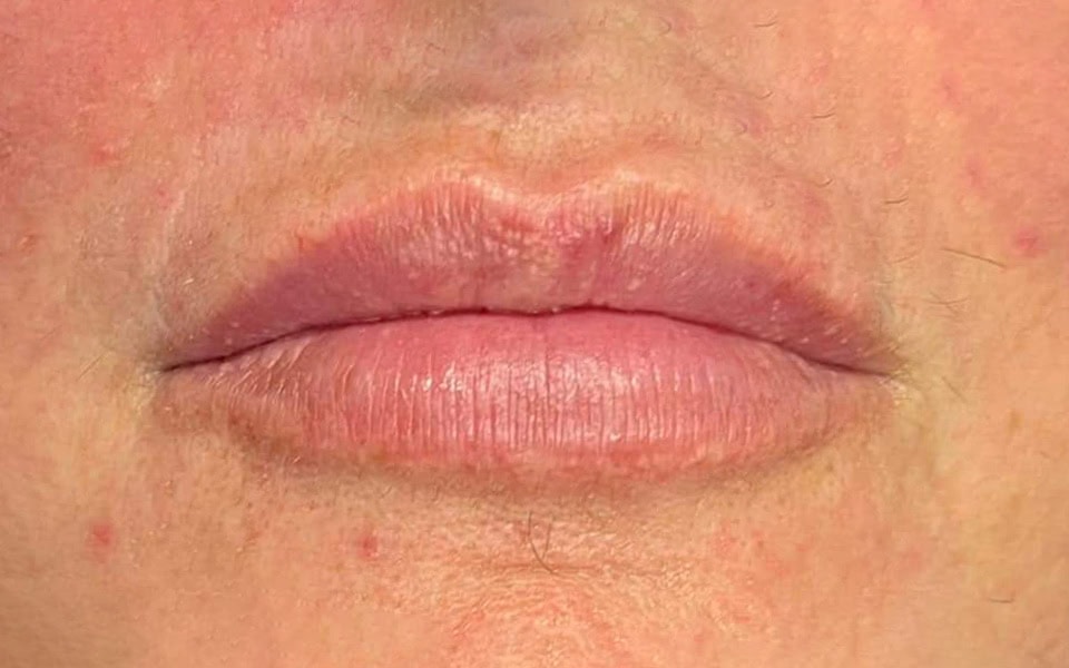 lip filler before 1