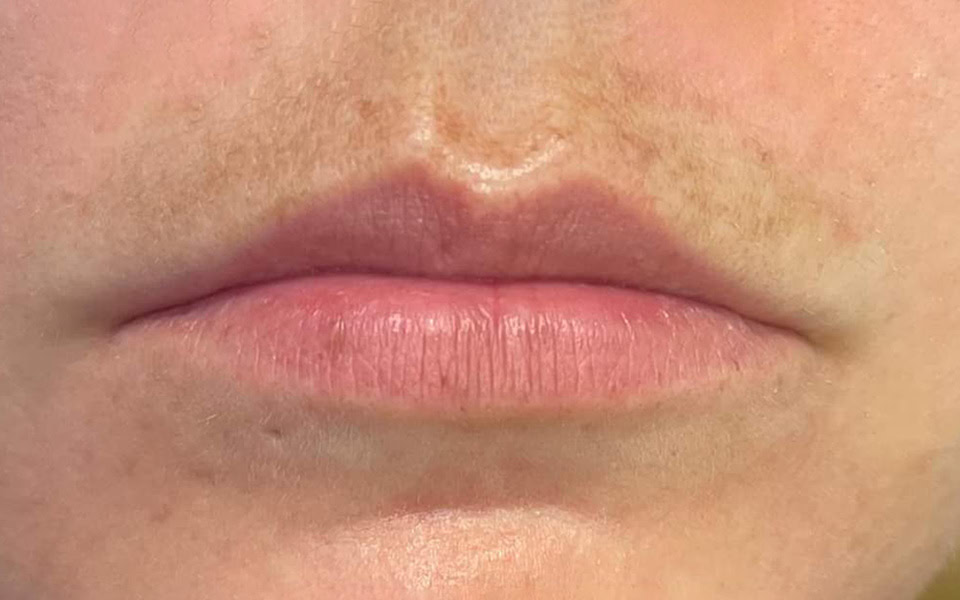 lip filler before 2