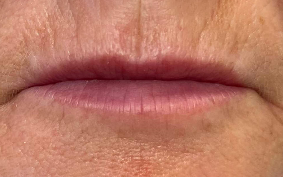 lip filler before 3