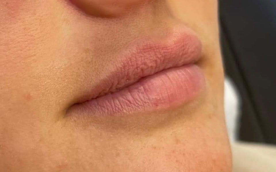 lip filler before 4