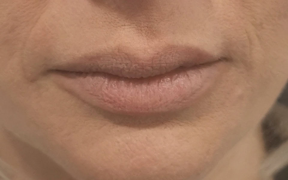 lip filler before 5
