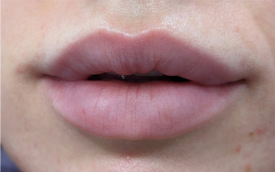 lip filler before 6